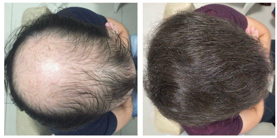 Transplante Capilar