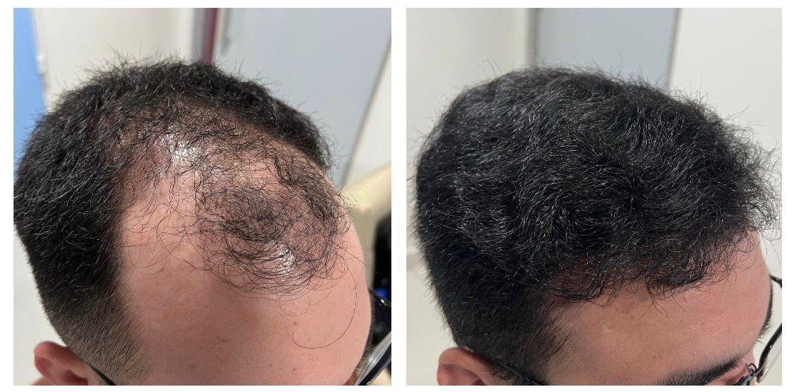 Transplante Capilar