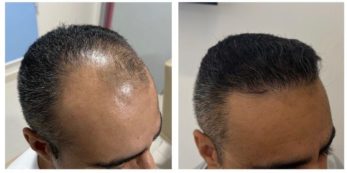 Transplante Capilar